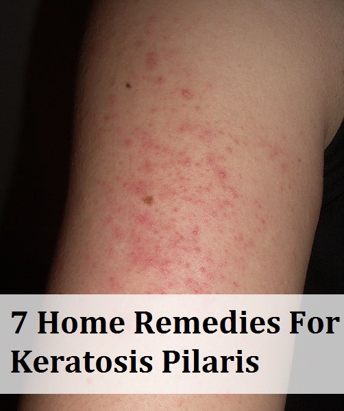 Keratosis Pilaris - Pictures, Symptoms, Causes, Treatment ...