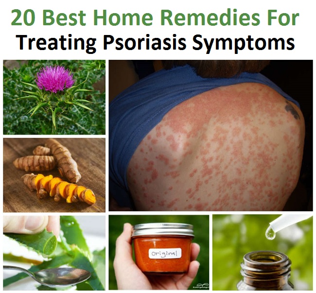 how to treat psoriasis