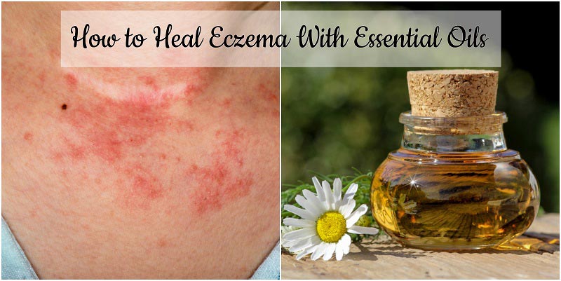 How to Heal Eczema With Essential Oils
