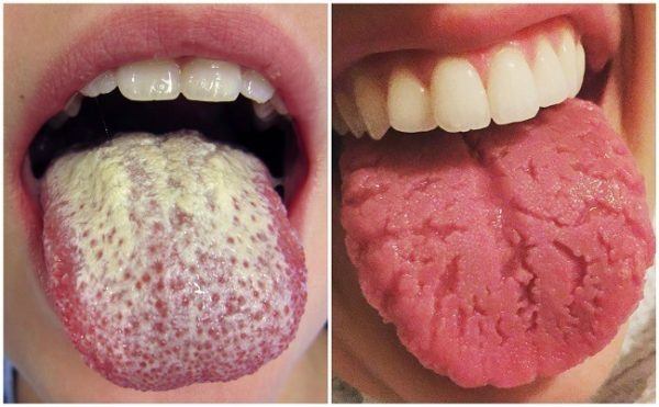 What are the little bumps on your tongue?