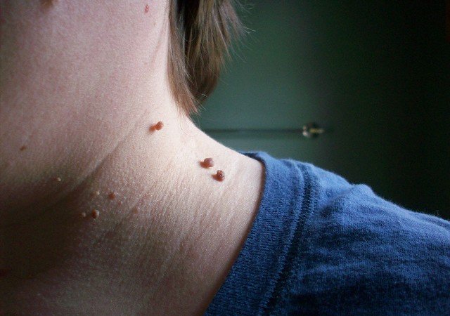 8 Home Remedies To Remove Skin Tags That Really Work