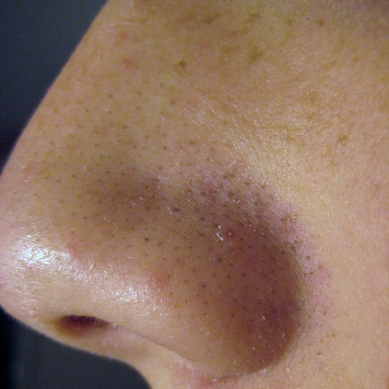 What are some methods for extracting blackheads from skin?