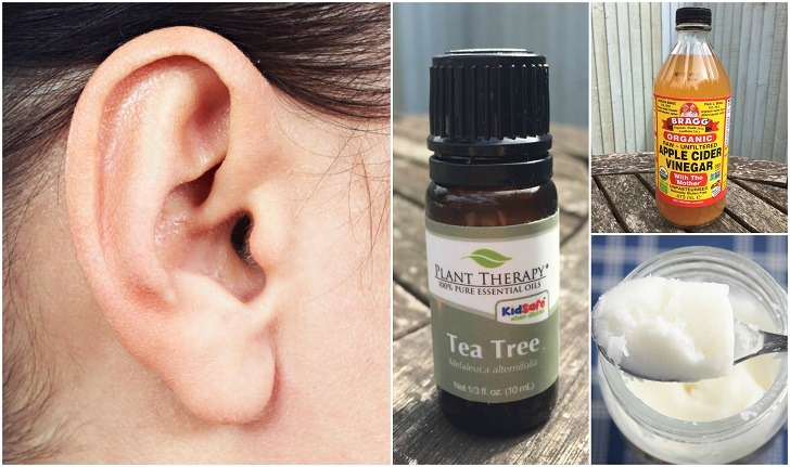 Home Remedies To Get Rid Of Earwax