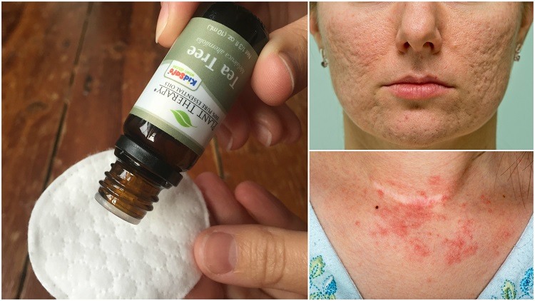 10 Reasons You Should Put Tea Tree Oil On Your Skin