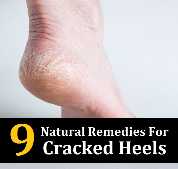 homeopathic medicine for cracked heels