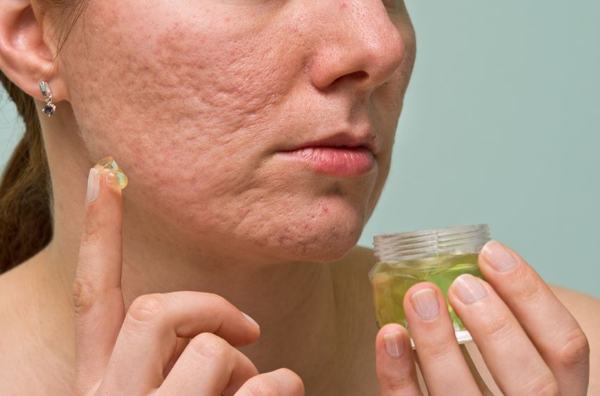 10 Most Effective Ways To Remove Acne Scars And Pimple Marks