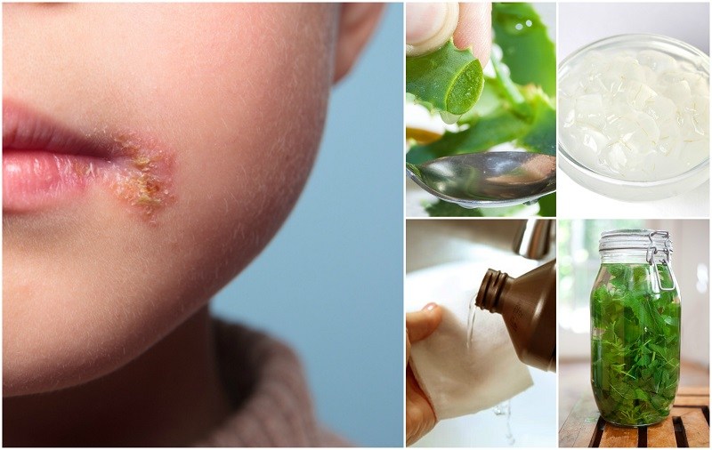 12 Home Remedies For Cold Sores Ranked By Effectiveness