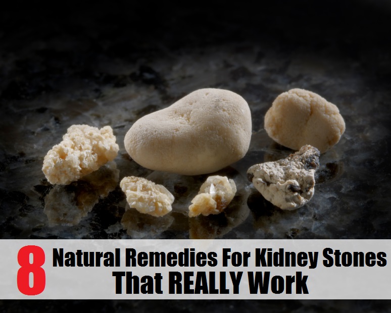 Top 8 Natural Remedies for Kidney Stones That Really Work