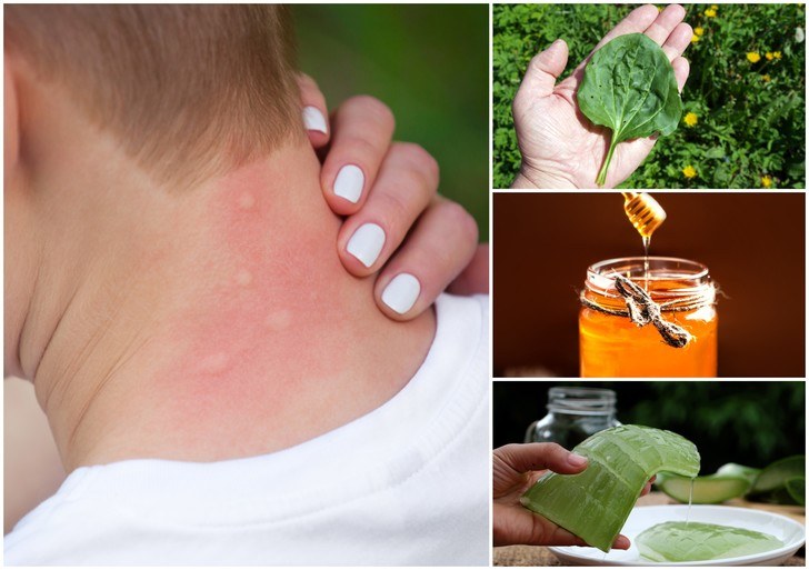 How To Get Rid Of Mosquito Bites: 15 Home Remedies For Instant Relief