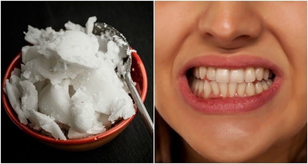 How To Whiten Teeth With Coconut Oil (+12 More Reasons To Put It In