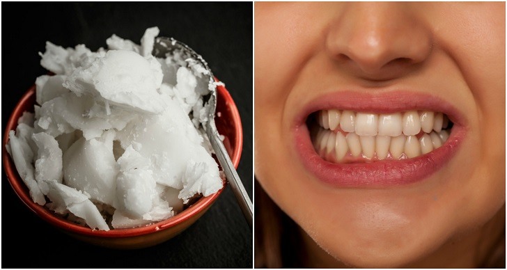 How To Whiten Teeth With Coconut Oil (+12 More Reasons To Put It In Your Mouth)